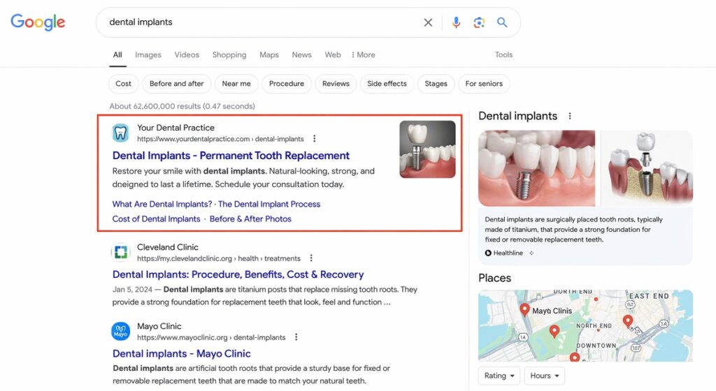 Google search results showing dental implant rankings with top listing highlighted for SEO performance analysis